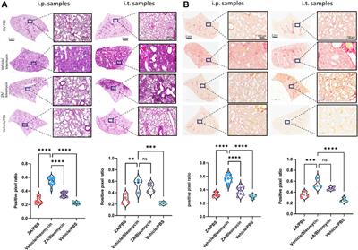 Zoledronic Acid Targeting of the Mevalonate Pathway Causes Reduced Cell Recruitment and Attenuates Pulmonary Fibrosis